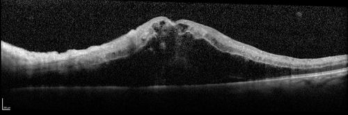 Trousseau Sign - CRVO and Pancreatic Cancer
Left eye shows CRVO with severe edema.  The right eye has multiple small hemorrhages.  Some of this is probably anemic retinopathy and some from hypercoaguability of cancer.  The patient has pancreatic cancer.
