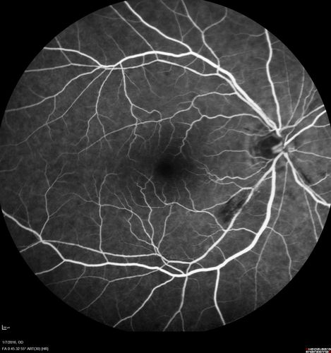 Trousseau Sign - CRVO and Pancreatic Cancer
Left eye shows CRVO with severe edema.  The right eye has multiple small hemorrhages.  Some of this is probably anemic retinopathy and some from hypercoaguability of cancer.  The patient has pancreatic cancer.
