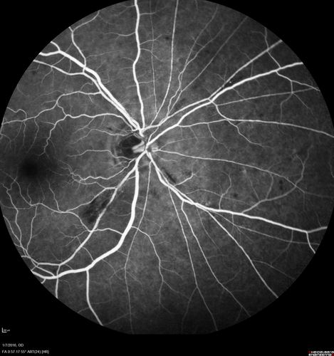 Trousseau Sign - CRVO and Pancreatic Cancer
Left eye shows CRVO with severe edema.  The right eye has multiple small hemorrhages.  Some of this is probably anemic retinopathy and some from hypercoaguability of cancer.  The patient has pancreatic cancer.
