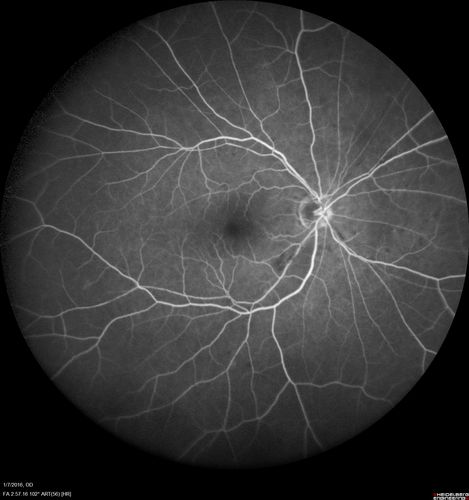 Trousseau Sign - CRVO and Pancreatic Cancer
Left eye shows CRVO with severe edema.  The right eye has multiple small hemorrhages.  Some of this is probably anemic retinopathy and some from hypercoaguability of cancer.  The patient has pancreatic cancer.
