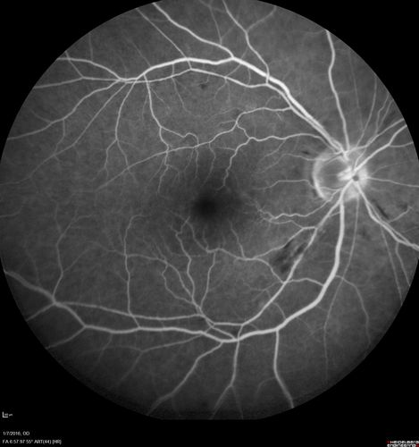 Trousseau Sign - CRVO and Pancreatic Cancer
Left eye shows CRVO with severe edema.  The right eye has multiple small hemorrhages.  Some of this is probably anemic retinopathy and some from hypercoaguability of cancer.  The patient has pancreatic cancer.
