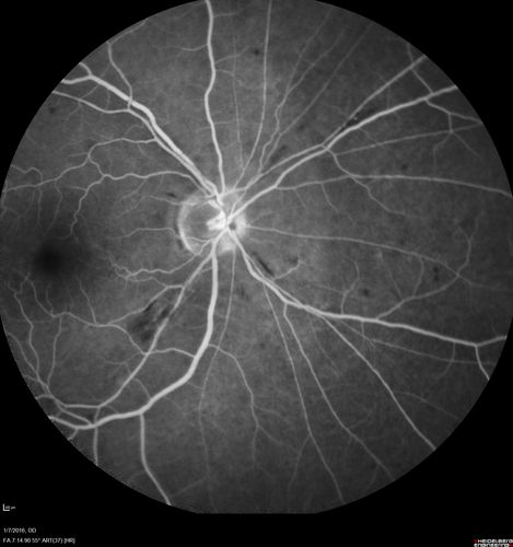 Trousseau Sign - CRVO and Pancreatic Cancer
Left eye shows CRVO with severe edema.  The right eye has multiple small hemorrhages.  Some of this is probably anemic retinopathy and some from hypercoaguability of cancer.  The patient has pancreatic cancer.
