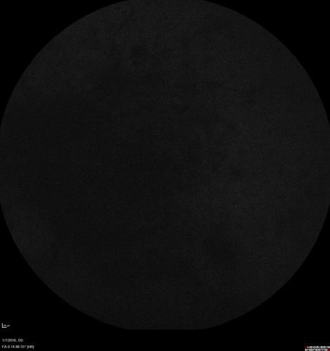Trousseau Sign - CRVO and Pancreatic Cancer
Left eye shows CRVO with severe edema.  The right eye has multiple small hemorrhages.  Some of this is probably anemic retinopathy and some from hypercoaguability of cancer.  The patient has pancreatic cancer.
