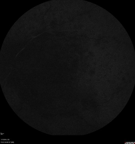 Trousseau Sign - CRVO and Pancreatic Cancer
Left eye shows CRVO with severe edema.  The right eye has multiple small hemorrhages.  Some of this is probably anemic retinopathy and some from hypercoaguability of cancer.  The patient has pancreatic cancer.
