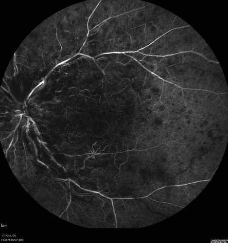Trousseau Sign - CRVO and Pancreatic Cancer
Left eye shows CRVO with severe edema.  The right eye has multiple small hemorrhages.  Some of this is probably anemic retinopathy and some from hypercoaguability of cancer.  The patient has pancreatic cancer.
