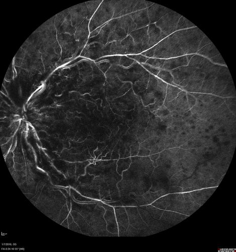 Trousseau Sign - CRVO and Pancreatic Cancer
Left eye shows CRVO with severe edema.  The right eye has multiple small hemorrhages.  Some of this is probably anemic retinopathy and some from hypercoaguability of cancer.  The patient has pancreatic cancer.

