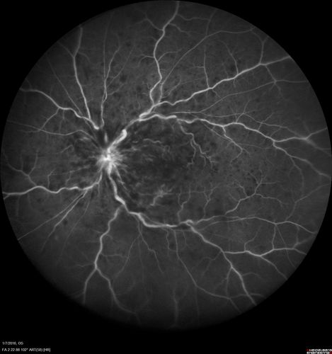 Trousseau Sign - CRVO and Pancreatic Cancer
Left eye shows CRVO with severe edema.  The right eye has multiple small hemorrhages.  Some of this is probably anemic retinopathy and some from hypercoaguability of cancer.  The patient has pancreatic cancer.
