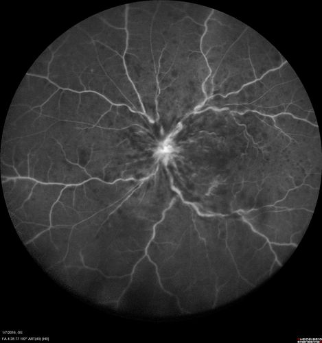 Trousseau Sign - CRVO and Pancreatic Cancer
Left eye shows CRVO with severe edema.  The right eye has multiple small hemorrhages.  Some of this is probably anemic retinopathy and some from hypercoaguability of cancer.  The patient has pancreatic cancer.
