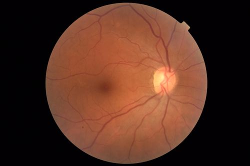 Central Retinal Vein Occlusion - No macular edema - Pre-foveal opercula
62 year old female with 20/20 vision.  She had been seeing a spot out of the left eye for 4 years and then noticed splotches in her vision.  She never devleoped edema or NV

