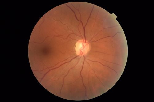 Central Retinal Vein Occlusion - No macular edema - Pre-foveal opercula
62 year old female with 20/20 vision.  She had been seeing a spot out of the left eye for 4 years and then noticed splotches in her vision.  She never devleoped edema or NV
