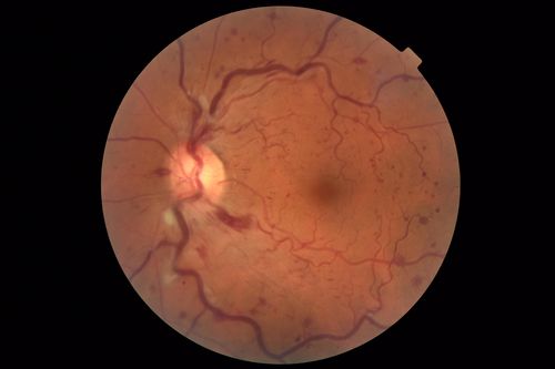 Central Retinal Vein Occlusion - No macular edema - Pre-foveal opercula
62 year old female with 20/20 vision.  She had been seeing a spot out of the left eye for 4 years and then noticed splotches in her vision.  She never devleoped edema or NV
