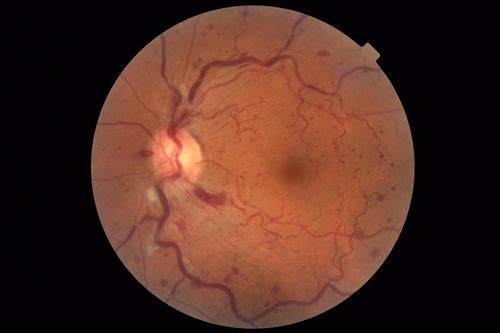 Central Retinal Vein Occlusion - No macular edema - Pre-foveal opercula
62 year old female with 20/20 vision.  She had been seeing a spot out of the left eye for 4 years and then noticed splotches in her vision.  She never devleoped edema or NV
