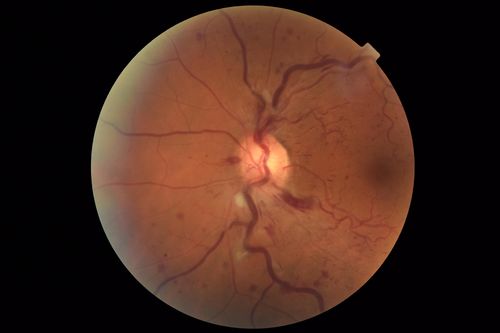 Central Retinal Vein Occlusion - No macular edema - Pre-foveal opercula
62 year old female with 20/20 vision.  She had been seeing a spot out of the left eye for 4 years and then noticed splotches in her vision.  She never devleoped edema or NV
