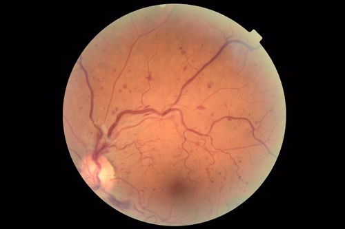Central Retinal Vein Occlusion - No macular edema - Pre-foveal opercula
62 year old female with 20/20 vision.  She had been seeing a spot out of the left eye for 4 years and then noticed splotches in her vision.  She never devleoped edema or NV
