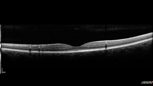 Central Retinal Vein Occlusion - No macular edema - Pre-foveal opercula
62 year old female with 20/20 vision.  She had been seeing a spot out of the left eye for 4 years and then noticed splotches in her vision.  She never devleoped edema or NV
