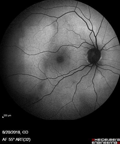 Central Retinal Vein Occlusion - No macular edema - Pre-foveal opercula
62 year old female with 20/20 vision.  She had been seeing a spot out of the left eye for 4 years and then noticed splotches in her vision.  She never devleoped edema or NV
