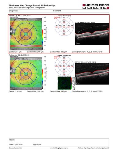 Central Retinal Vein Occlusion - No macular edema - Pre-foveal opercula
62 year old female with 20/20 vision.  She had been seeing a spot out of the left eye for 4 years and then noticed splotches in her vision.  She never devleoped edema or NV
