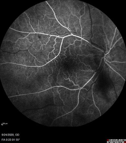Central Retinal Vein Occlusion following Cataract Surgery
79 year old man with decreased vision The patient had cataract surgery in the right eye 9 days ago and in the left eye 21 days ago and presents with vision loss in the right eye. 

Meds: HCTZ, Garlic, Tumeric
VA 20/60 OD, 20/25 OS
