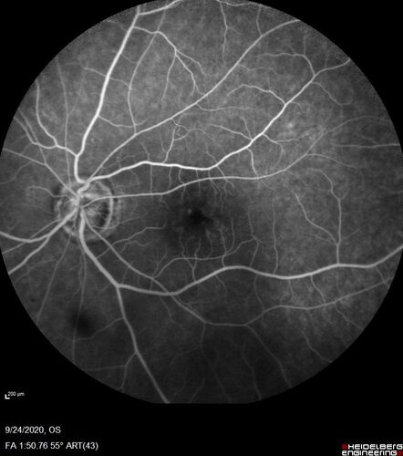 Central Retinal Vein Occlusion following Cataract Surgery
79 year old man with decreased vision The patient had cataract surgery in the right eye 9 days ago and in the left eye 21 days ago and presents with vision loss in the right eye. 

Meds: HCTZ, Garlic, Tumeric
VA 20/60 OD, 20/25 OS
