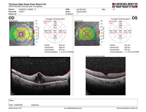 Central Retinal Vein Occlusion following Cataract Surgery
79 year old man with decreased vision The patient had cataract surgery in the right eye 9 days ago and in the left eye 21 days ago and presents with vision loss in the right eye. 

Meds: HCTZ, Garlic, Tumeric
VA 20/60 OD, 20/25 OS
