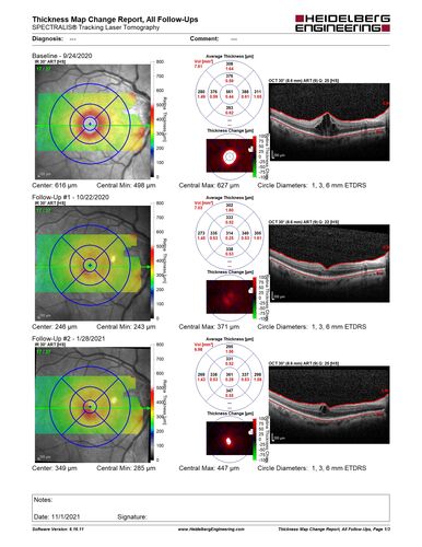 Central Retinal Vein Occlusion following Cataract Surgery
79 year old man with decreased vision The patient had cataract surgery in the right eye 9 days ago and in the left eye 21 days ago and presents with vision loss in the right eye. 

Meds: HCTZ, Garlic, Tumeric
VA 20/60 OD, 20/25 OS
