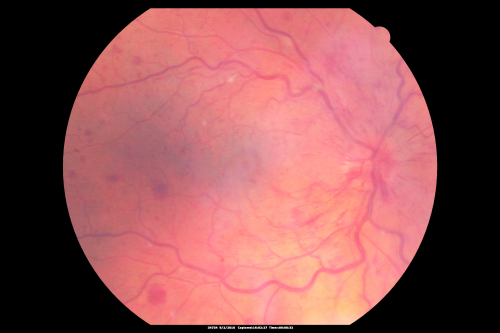 Central Retinal Vein Occlusion Recurrent Edema 6 weeks after Lucentis - Nonperfusion Temporally
66-year-old woman has a central retinal vein occlusion in the right eye with macular edema.  She had intravitreal Lucentis treatment six weeks ago and she has noticed over the last week or two her vision is declining.
 
VISUAL ACUITY:  OD 20/70, OS 20/30.  
