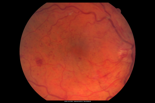 Central Retinal Vein Occlusion Recurrent Edema 6 weeks after Lucentis - Nonperfusion Temporally
66-year-old woman has a central retinal vein occlusion in the right eye with macular edema.  She had intravitreal Lucentis treatment six weeks ago and she has noticed over the last week or two her vision is declining.
 
VISUAL ACUITY:  OD 20/70, OS 20/30.  
