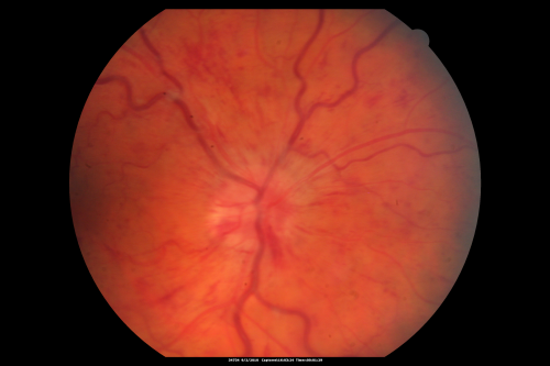 Central Retinal Vein Occlusion Recurrent Edema 6 weeks after Lucentis - Nonperfusion Temporally
66-year-old woman has a central retinal vein occlusion in the right eye with macular edema.  She had intravitreal Lucentis treatment six weeks ago and she has noticed over the last week or two her vision is declining.
 
VISUAL ACUITY:  OD 20/70, OS 20/30.  
