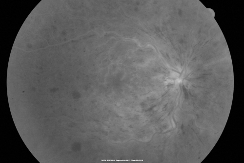 Central Retinal Vein Occlusion Recurrent Edema 6 weeks after Lucentis - Nonperfusion Temporally
66-year-old woman has a central retinal vein occlusion in the right eye with macular edema.  She had intravitreal Lucentis treatment six weeks ago and she has noticed over the last week or two her vision is declining.
 
VISUAL ACUITY:  OD 20/70, OS 20/30.  
