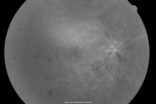 Central Retinal Vein Occlusion Recurrent Edema 6 weeks after Lucentis - Nonperfusion Temporally
66-year-old woman has a central retinal vein occlusion in the right eye with macular edema.  She had intravitreal Lucentis treatment six weeks ago and she has noticed over the last week or two her vision is declining.
 
VISUAL ACUITY:  OD 20/70, OS 20/30.  
