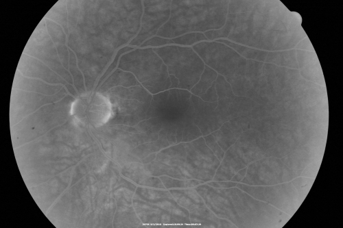 Central Retinal Vein Occlusion Recurrent Edema 6 weeks after Lucentis - Nonperfusion Temporally
66-year-old woman has a central retinal vein occlusion in the right eye with macular edema.  She had intravitreal Lucentis treatment six weeks ago and she has noticed over the last week or two her vision is declining.
 
VISUAL ACUITY:  OD 20/70, OS 20/30.  
