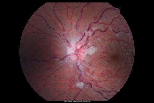 CRVO 25 year old man - Heterozygous Factor V Leiden
20/100 initial vision.  Improved to 20/30 with Lucentis which continued for 3 years, treat and extend, and stopped.

