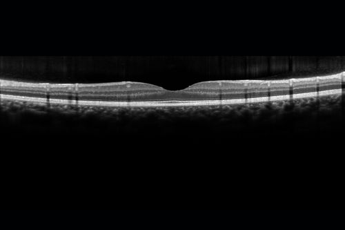 CRVO 25 year old man - Heterozygous Factor V Leiden
20/100 initial vision.  Improved to 20/30 with Lucentis which continued for 3 years, treat and extend, and stopped.
