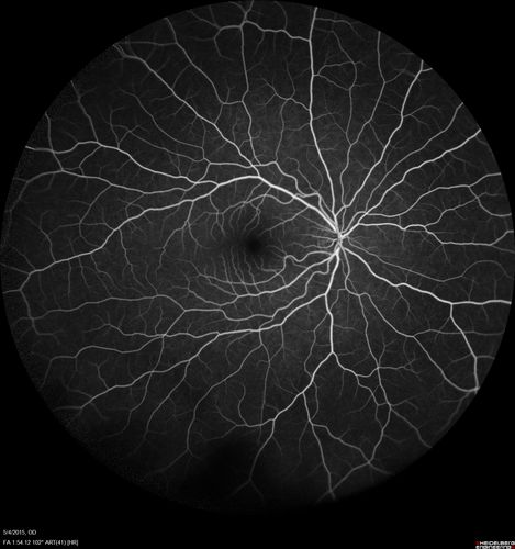 CRVO 25 year old man - Heterozygous Factor V Leiden
20/100 initial vision.  Improved to 20/30 with Lucentis which continued for 3 years, treat and extend, and stopped.

