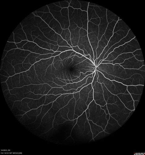 CRVO 25 year old man - Heterozygous Factor V Leiden
20/100 initial vision.  Improved to 20/30 with Lucentis which continued for 3 years, treat and extend, and stopped.
