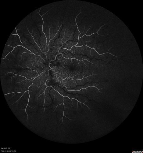 CRVO 25 year old man - Heterozygous Factor V Leiden
20/100 initial vision.  Improved to 20/30 with Lucentis which continued for 3 years, treat and extend, and stopped.

