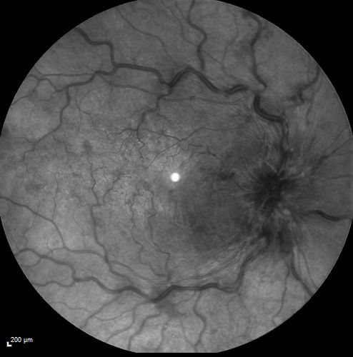 Mtehylenetetrahydrofolate reductase c677T homozygous CRVO pregnant woman (MTHFR)
Vision improved from 20/50 to 20/16 in one month following ozurdex injections.  38 year old woman with only one eye.  The left eye was removed as a child for retinoblastoma.
