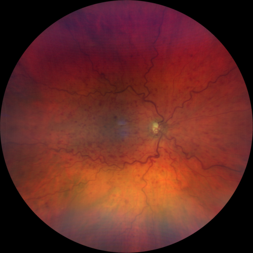 Non-ischemic Central Retinal Vein Occlusion with Macular Edema
62 year old man The vision in the right eye started to decline about 10 days ago.  Prior to that the two eyes were about the same.  
VA OD: Dcc20/125 PH20/50-2
VA OS: Dcc20/20
IOP: TP: OD:21 OS:21
