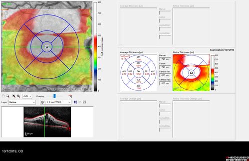 Non-ischemic Central Retinal Vein Occlusion with Macular Edema
62 year old man The vision in the right eye started to decline about 10 days ago.  Prior to that the two eyes were about the same.  
VA OD: Dcc20/125 PH20/50-2
VA OS: Dcc20/20
IOP: TP: OD:21 OS:21
