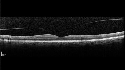 Non-ischemic Central Retinal Vein Occlusion with Macular Edema
62 year old man The vision in the right eye started to decline about 10 days ago.  Prior to that the two eyes were about the same.  
VA OD: Dcc20/125 PH20/50-2
VA OS: Dcc20/20
IOP: TP: OD:21 OS:21
