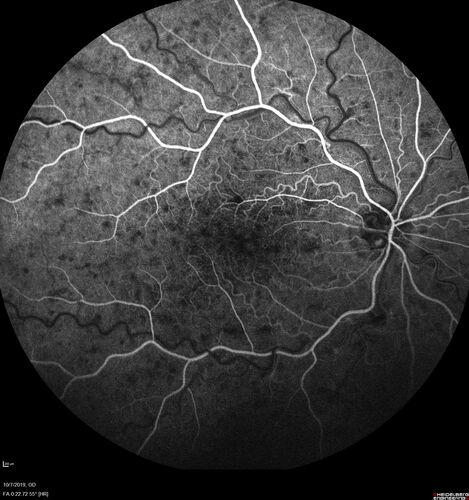 Non-ischemic Central Retinal Vein Occlusion with Macular Edema
62 year old man The vision in the right eye started to decline about 10 days ago.  Prior to that the two eyes were about the same.  
VA OD: Dcc20/125 PH20/50-2
VA OS: Dcc20/20
IOP: TP: OD:21 OS:21
