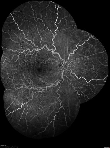 Non-ischemic Central Retinal Vein Occlusion with Macular Edema
62 year old man The vision in the right eye started to decline about 10 days ago.  Prior to that the two eyes were about the same.  
VA OD: Dcc20/125 PH20/50-2
VA OS: Dcc20/20
IOP: TP: OD:21 OS:21
