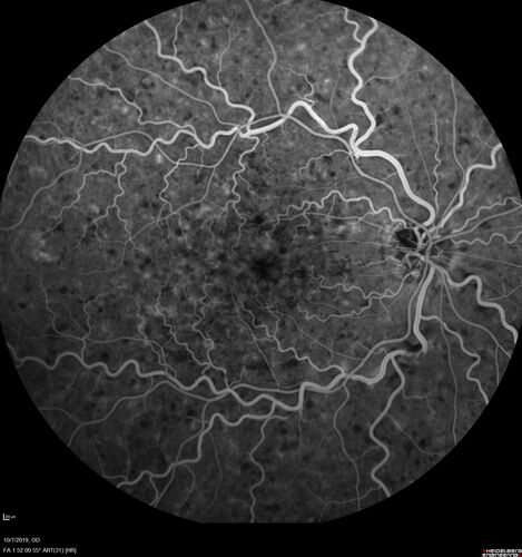 Non-ischemic Central Retinal Vein Occlusion with Macular Edema
62 year old man The vision in the right eye started to decline about 10 days ago.  Prior to that the two eyes were about the same.  
VA OD: Dcc20/125 PH20/50-2
VA OS: Dcc20/20
IOP: TP: OD:21 OS:21
