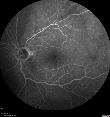Non-ischemic Central Retinal Vein Occlusion with Macular Edema
62 year old man The vision in the right eye started to decline about 10 days ago.  Prior to that the two eyes were about the same.  
VA OD: Dcc20/125 PH20/50-2
VA OS: Dcc20/20
IOP: TP: OD:21 OS:21
