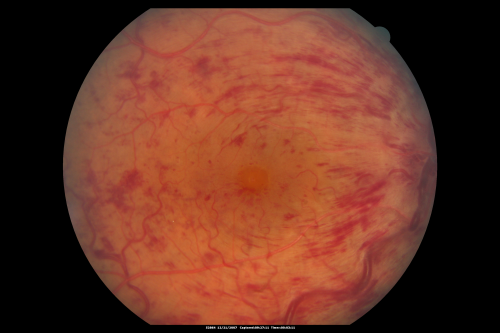 49-year-old woman has central retinal vein occlusion right eye with fluctuating vision for a few month now with  OD 20/100.  IOP: OD 20
