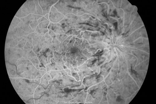 49-year-old woman has central retinal vein occlusion right eye with fluctuating vision for a few month now with  OD 20/100.  IOP: OD 20
