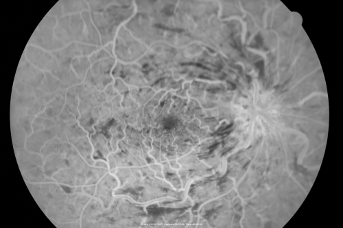 49-year-old woman has central retinal vein occlusion right eye with fluctuating vision for a few month now with  OD 20/100.  IOP: OD 20
