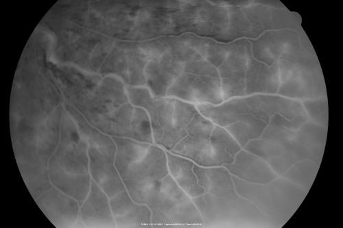 49-year-old woman has central retinal vein occlusion right eye with fluctuating vision for a few month now with  OD 20/100.  IOP: OD 20
