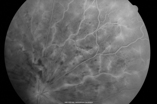 49-year-old woman has central retinal vein occlusion right eye with fluctuating vision for a few month now with  OD 20/100.  IOP: OD 20

