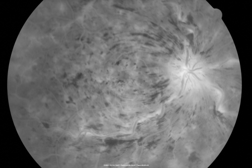 49-year-old woman has central retinal vein occlusion right eye with fluctuating vision for a few month now with  OD 20/100.  IOP: OD 20
